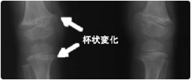 図2：くる病の単純X線写真(提供：大阪大学大学院医学系研究科 内科系臨床医学 情報統合医学講座 小児科学 教授 大薗 恵一 先生)