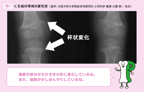 図２ くる病の単純X線写真（提供：大阪大学大学院医学系研究科 小児科学 教授 大薗 恵一 先生） 杯状変化 関節の部分がさかずきの形に変化しているね。また、関節が少しぼんやりしているね。